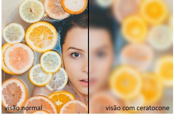 Ceratocone: Pesquisa revela que 45,8% da população não tem conhecimento sobre a condição