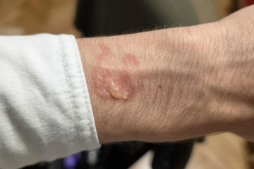 Galaxy Watch gera alarme entre consumidores devido a relatos de queimaduras e bolhas na pele
